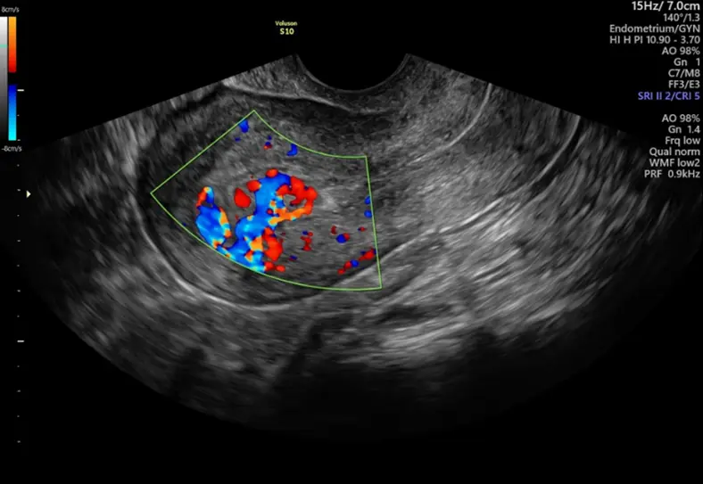 RPOC: Understanding Persistent Bleeding After Delivery or Miscarriage