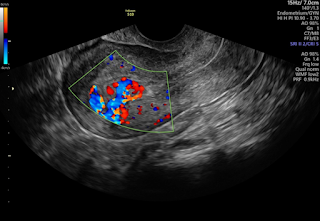 RPOC: Understanding Persistent Bleeding After Delivery or Miscarriage